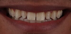 antes