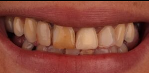 antes1