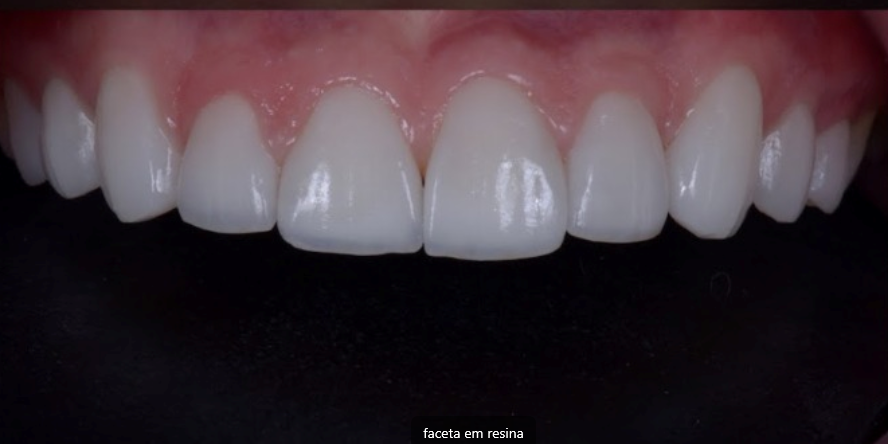 faceta02